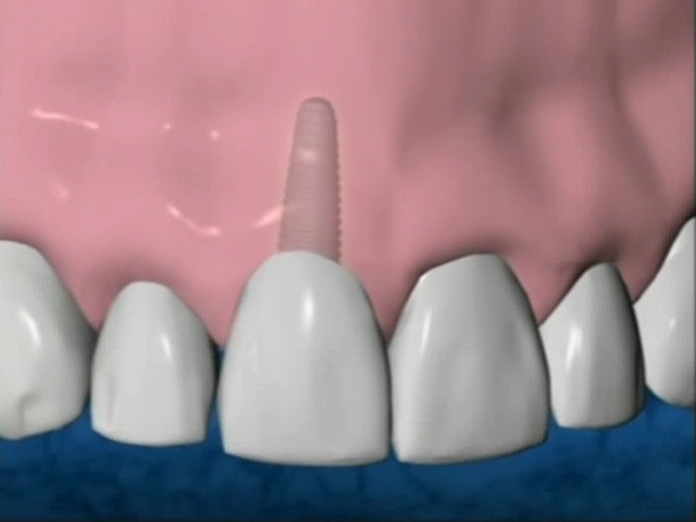 Medicaid Program and Dental Implants